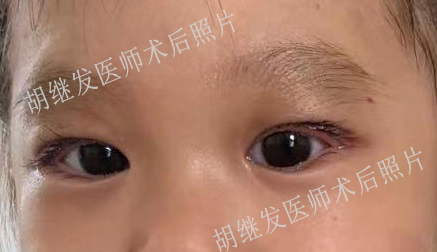 上瞼下垂術后照片