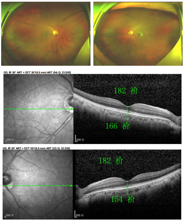糖尿病視網(wǎng)膜病變