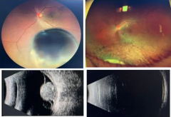 以為只是眼花，竟查出眼內(nèi)惡性腫瘤！50歲男子及時就醫(yī)后，獲“保眼”治療機會！